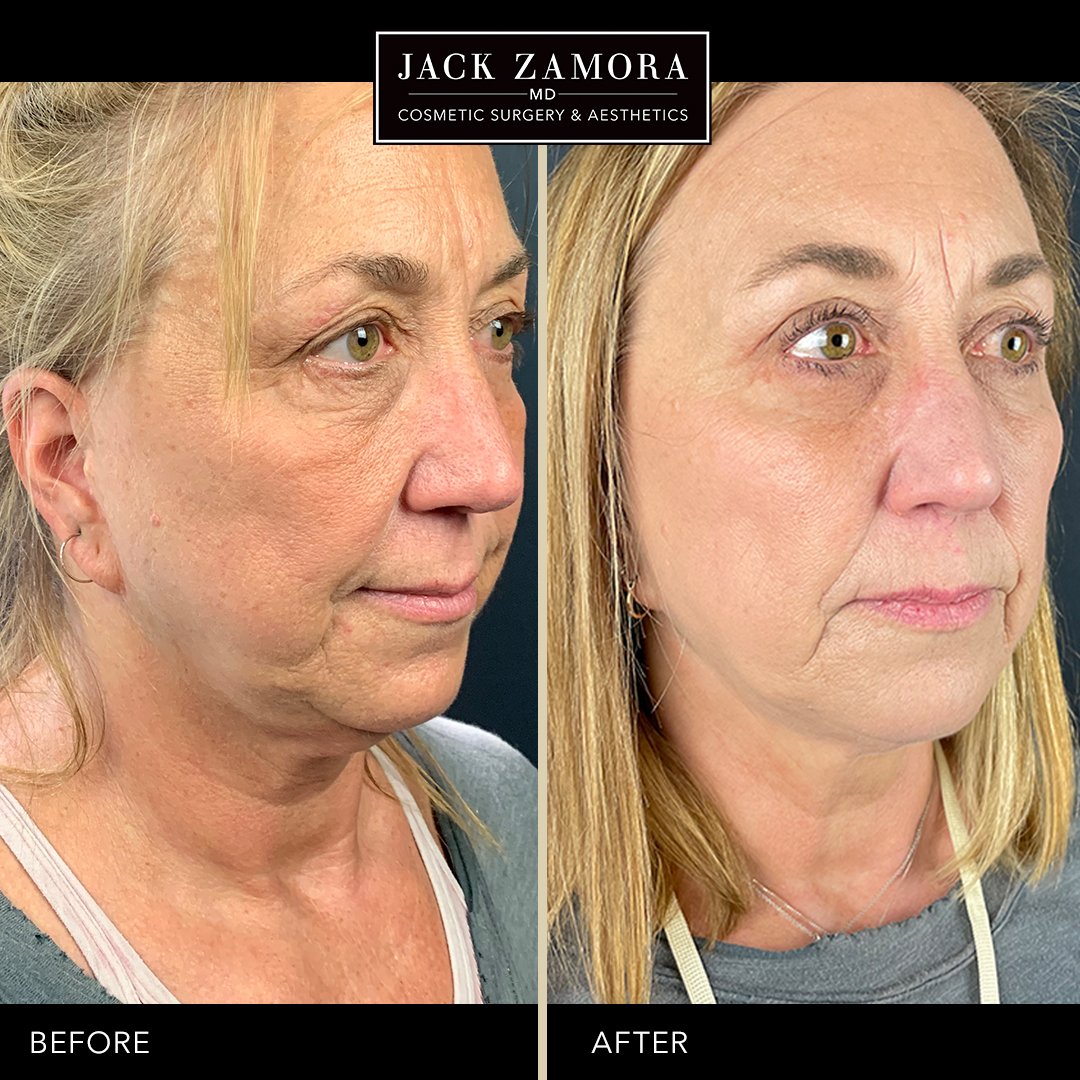 Jack Zamora MD Cosmetic Surgery and Aesthetics - Facelift & Neck